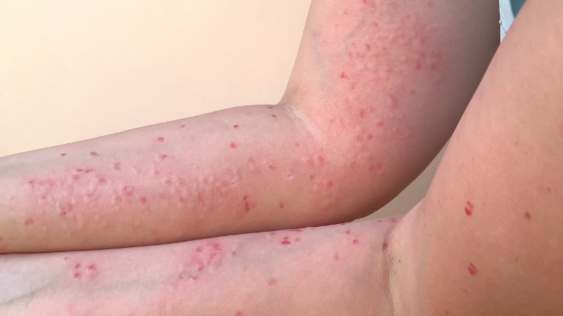 symptomen van apenpokken